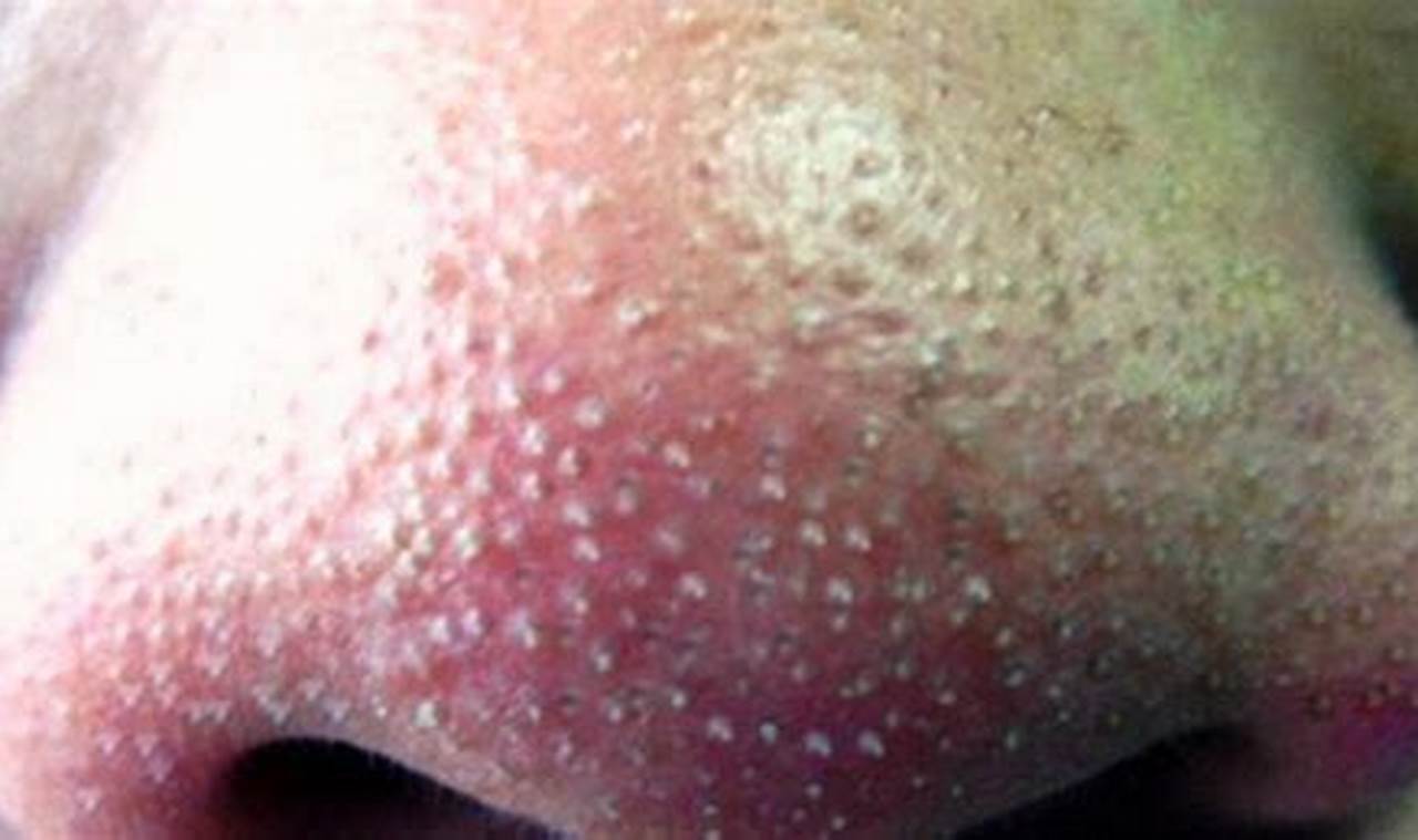 Cara Mengatasi Komedo Di Hidung